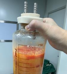 柳州水动力吸脂手术要做多久？